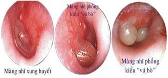 Viêm tai giữa cấp tính - Hình ảnh minh họa